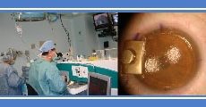 Refractive surgery (myopia, hyperopia & astigmatism)