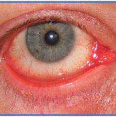 Eyelid condition