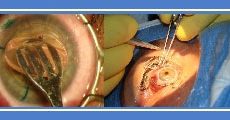 Transplante de córnea (instructivo)
